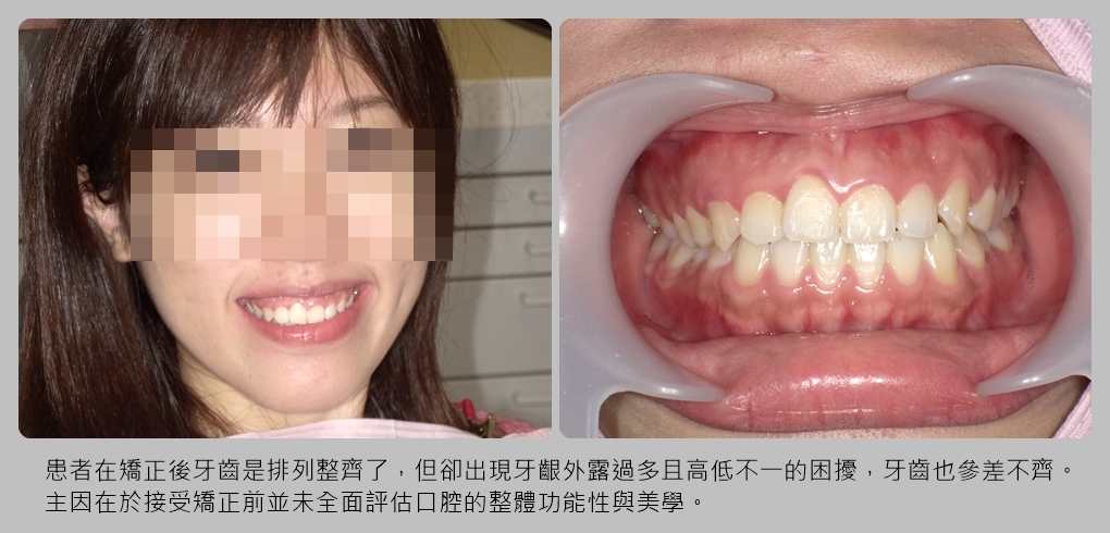 矫正后牙龈外露又不齐 靠上唇定位术 美齿贴片挽救